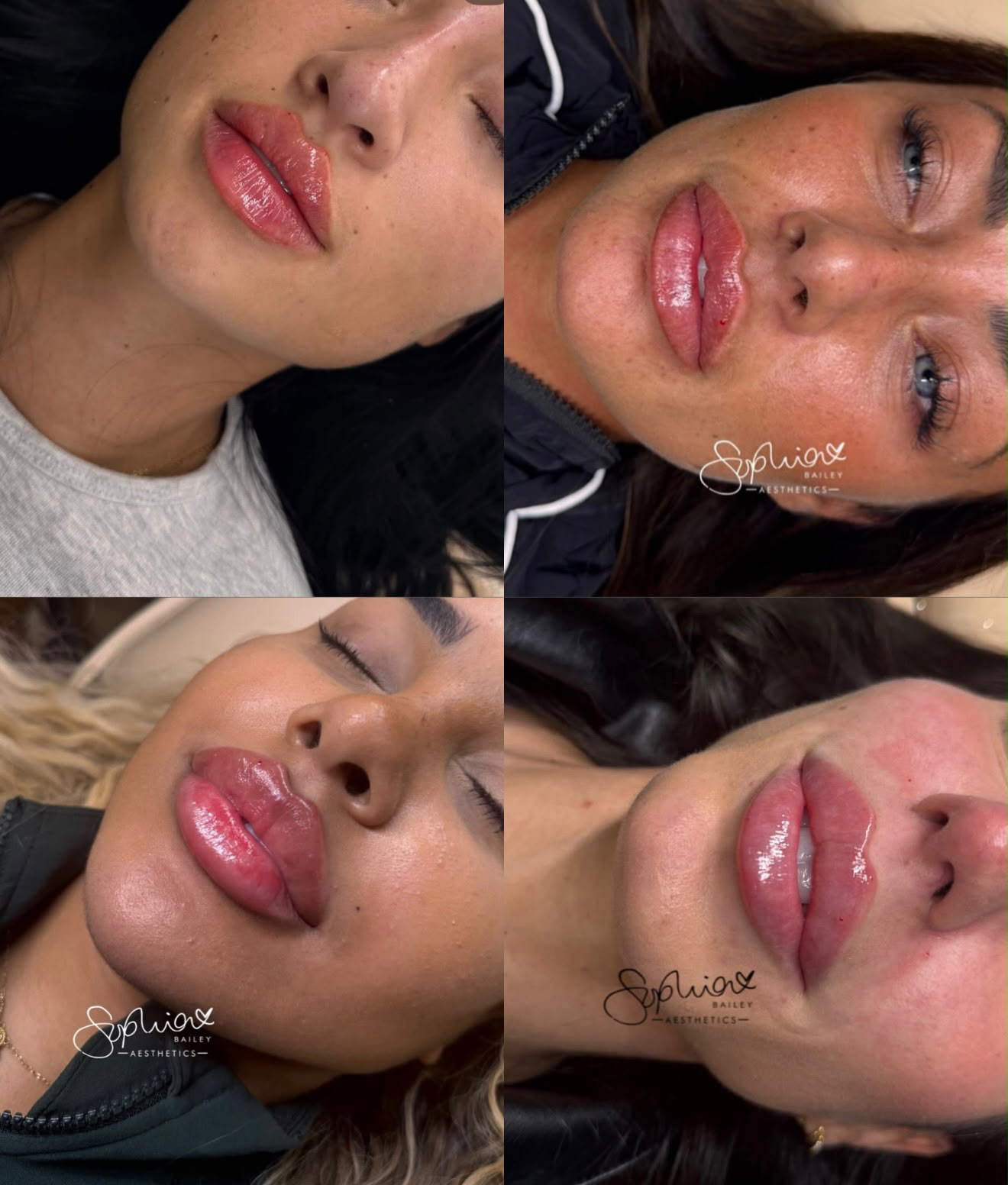 Advanced lip filler results collage by Sophia Bailey Aesthetics